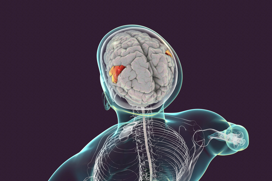 Aphasia affects the part of the brain involved in perception of language, limb location, identifying postures and gestures of other people.