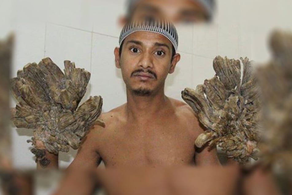 Abul Bajandar (29) leidet seit vielen Jahren an der selten Krankheit, die ihn in hohem Maße einschränkt und starke Schmerzen verursacht.