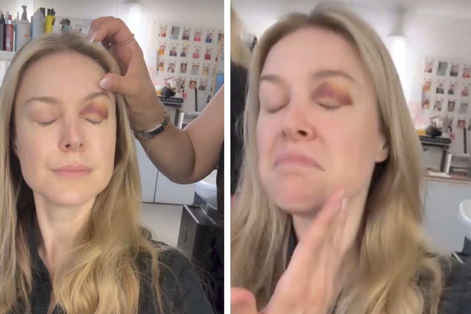 Nina Ensmann (41) ist gegen eine Aufzugstür geknallt - und zog sich dabei ein Veilchen zu.