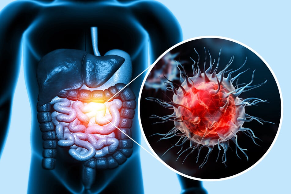 Vier Symptome, welche die Diagnose von Darmkrebs beschleunigen können