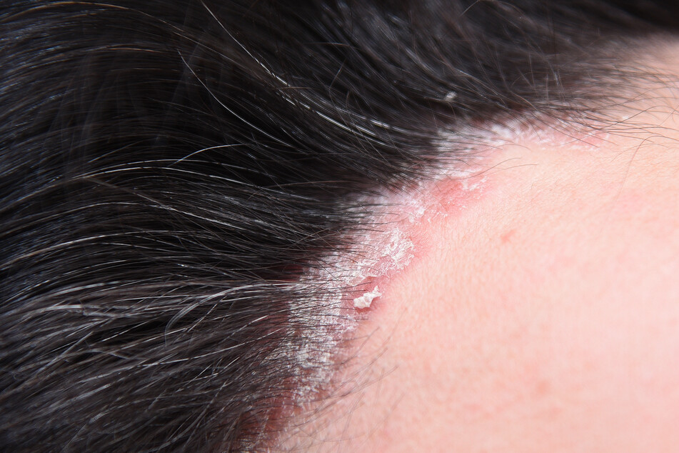 Psoriasis often manifests on the scalp (stock image).
