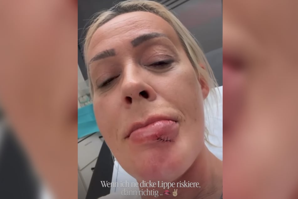 Insgesamt sechs Stiche waren nötig, um die klaffende Wunde zu schließen.