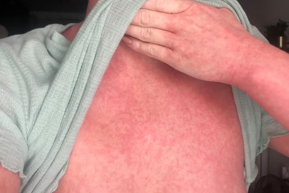 Betroffene, wie Bethany Norman, berichten von starker Hautrötung, Brennen und ausgeprägtem Juckreiz.