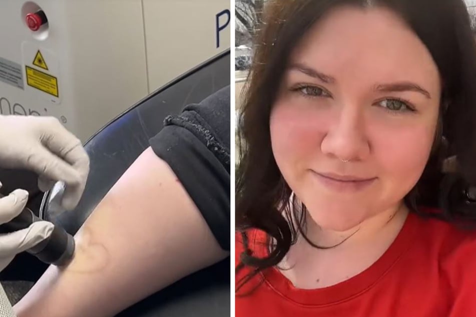 Katherine (27) hat seit Monaten Sessions bei ihrer Hautärztin, um ein unliebsames Tattoo loszuwerden.