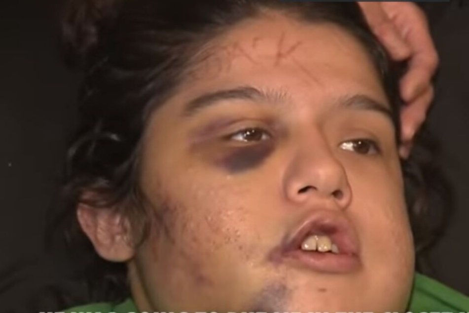 Catalina Mireles (22) erlitt unter anderem einen dreifachen Kieferbruch.
