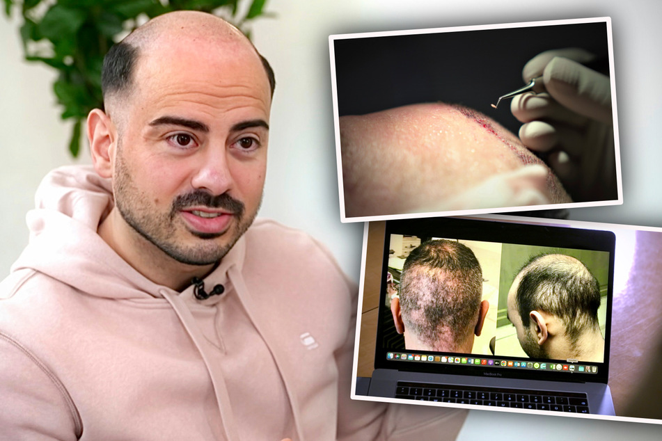 Reportage: So dreist werden Haarausfall-Betroffene oft abgezockt