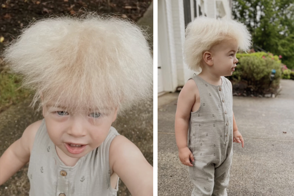 Mit fast zwei Jahren trägt der Junge eine unglaubliche Mähne auf dem Kopf. Grund ist ein seltenes Syndrom.