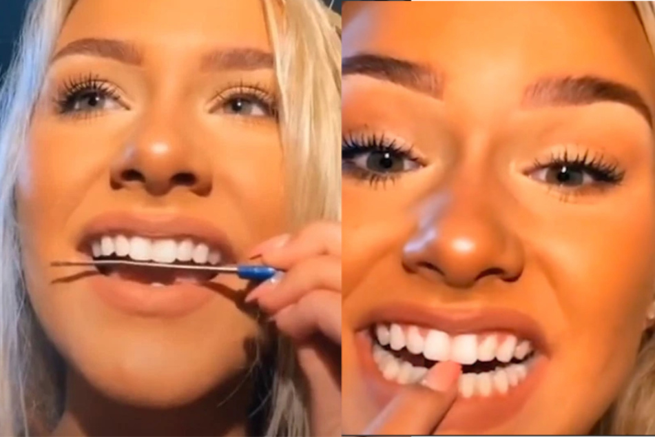 Gefährlicher TikTok-Trend: Influencer glätten Zähne mit Nagelfeile