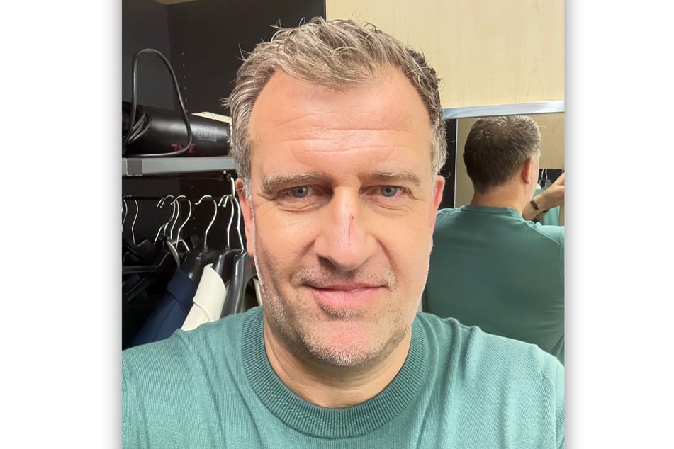 Autsch: Der Pfotenschlag von Mops Cookie hinterließ auf der Nase von René Kindermann (50) Spuren.