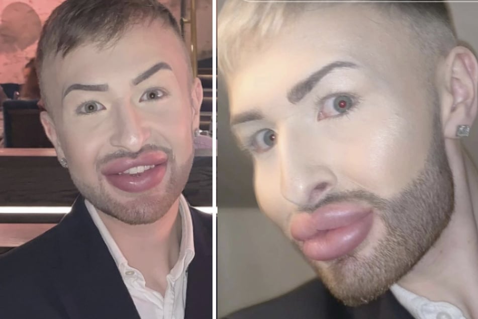 Ab dem zarten Alter von 17 Jahren ließ sich Christopher Sharratt Filler ins Gesicht spritzen.