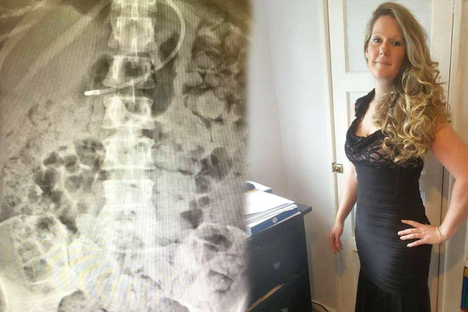 Kate Yeoman (rechts) wurde bei einem Eingriff der Blinddarm verletzt. Seitdem bewegen sich die Fäkalien durch ihren gesamten Körper (rechts).