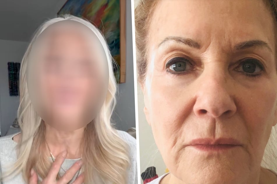 70-Jährige will wieder jung aussehen: Das hat ein Facelifting aus ihr gemacht