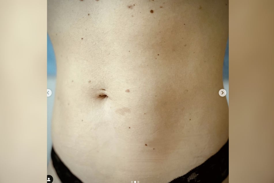 Madita van Hülsen (40) präsentiert ihren Bauch auf Instagram.