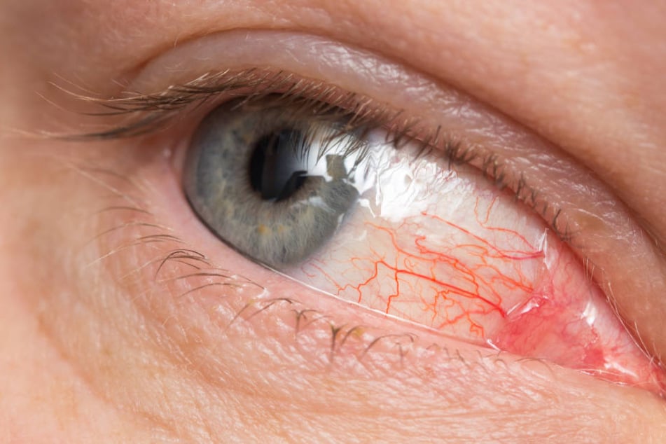 Pfusch bei der Wimpern-Verlängerung kann zu heftigen Reaktionen in den Augen führen.