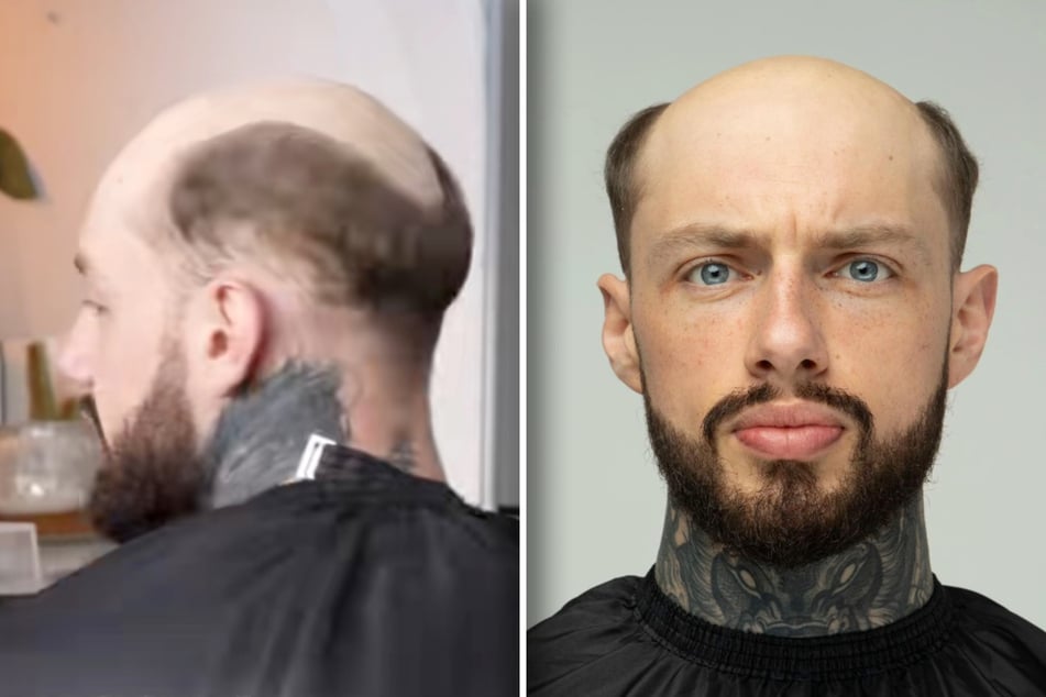 Schon mit 18 Jahren eine Glatze: Als sich junger Mann mit vollem Haar sieht, ist er sprachlos