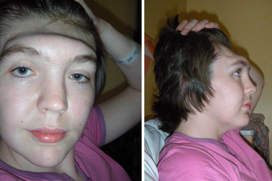Durch den Unfall wurde die Stirn der damals 22-Jährigen nach hinten gedrückt, sodass es aussah, als würde ein Stück fehlen.