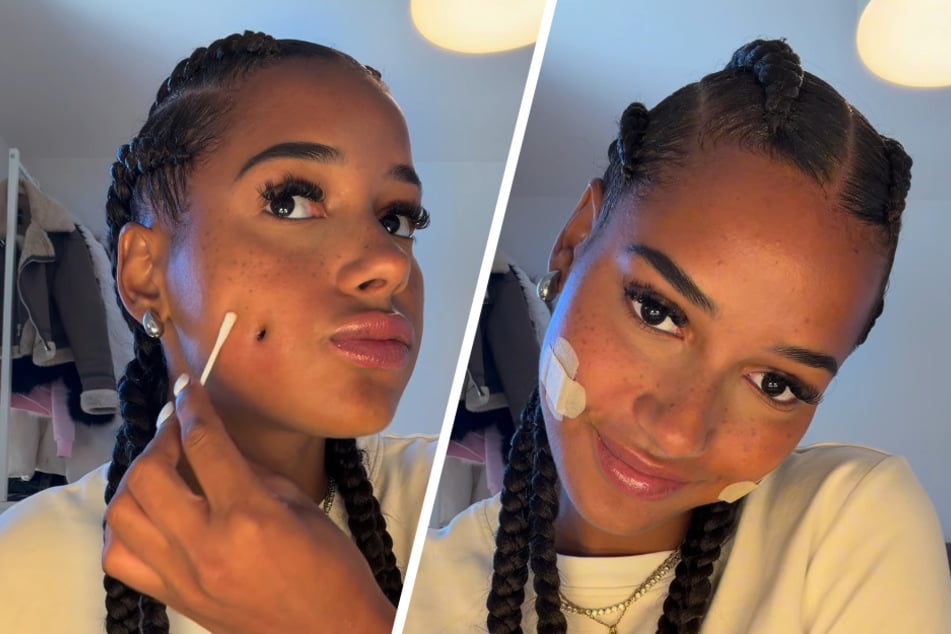 Wenige Tage nach dem Eingriff schützt Brenda ihre künstlichen Grübchen noch mit Pflastern.