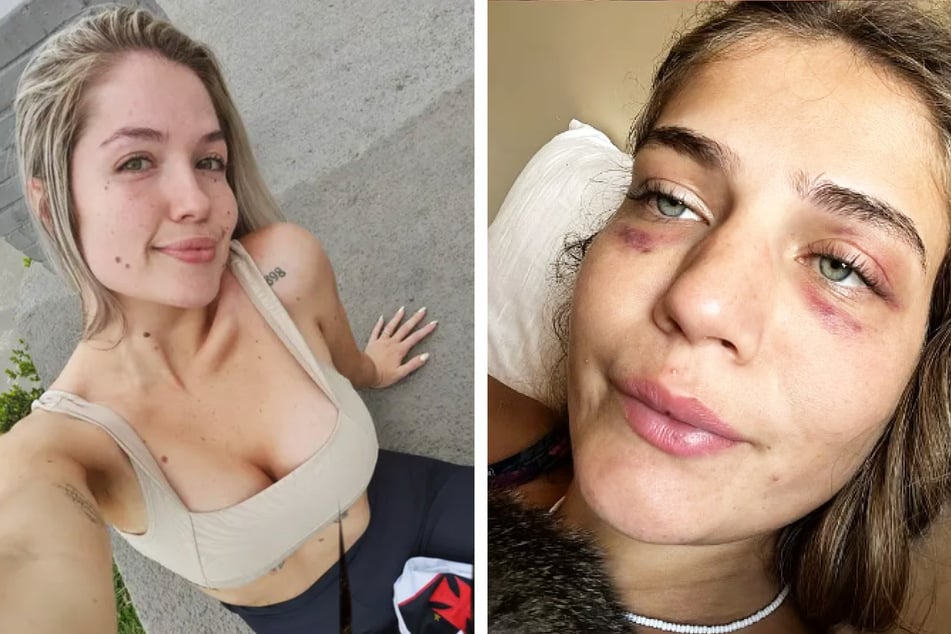 Anwältin und Bloggerin Larissa Ferrari (28) hat Fotos ihrer Verletzungen auf Instagram geteilt.