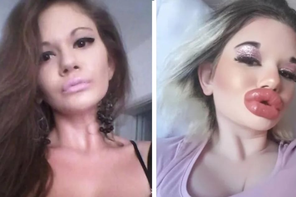 2018 begann Andrea Ivanova damit, sich die Lippen aufzuspritzen und sieht nun völlig anders aus.