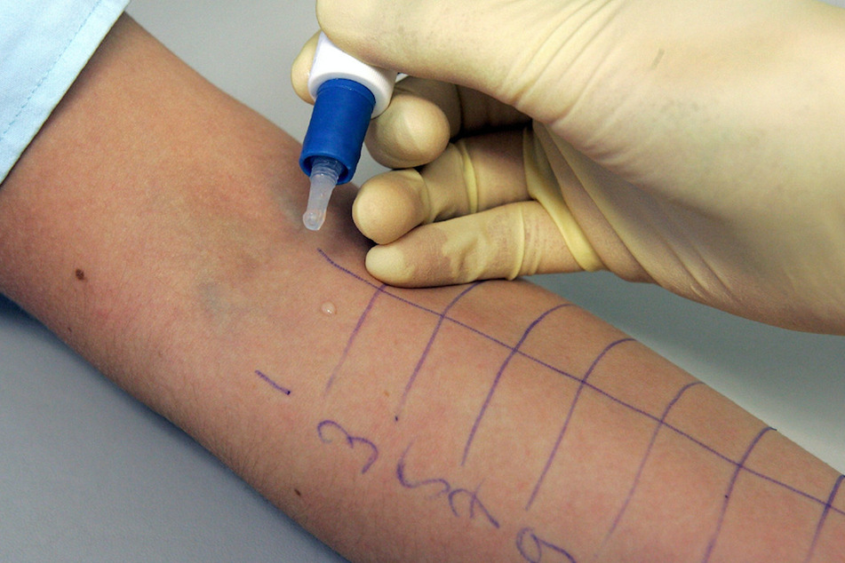 Auf dem Unterarm einer Patientin wird ein Allergie-Test durchgeführt. (Symbolbild)