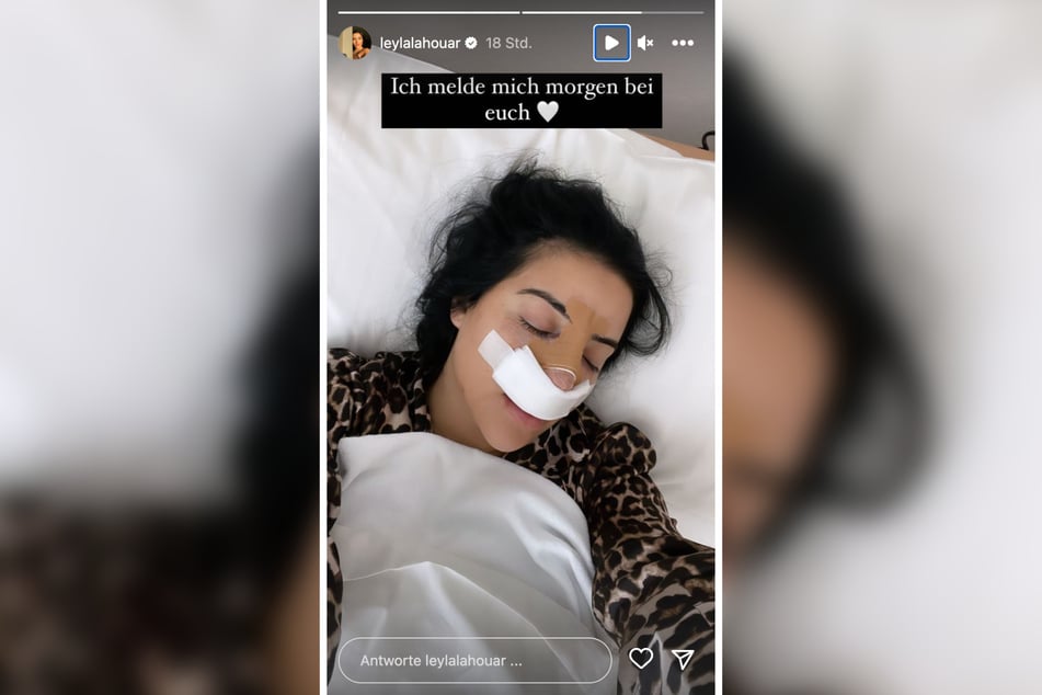 In ihrer aktuellen Instagram-Story zeigte sich die 27-jährige Influencerin kurz nach ihrer Nasen-OP.