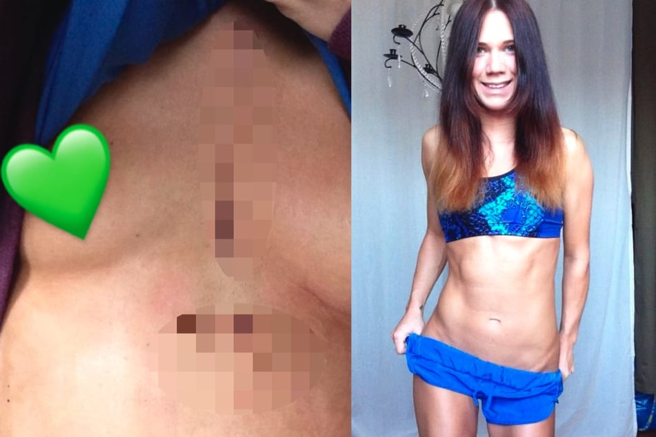 Louisa Dellert (32) nach ihrer Operation (l.). Auf dem rechten Bild zeigt sie das Ergebnis ihres radikalen Lebens.