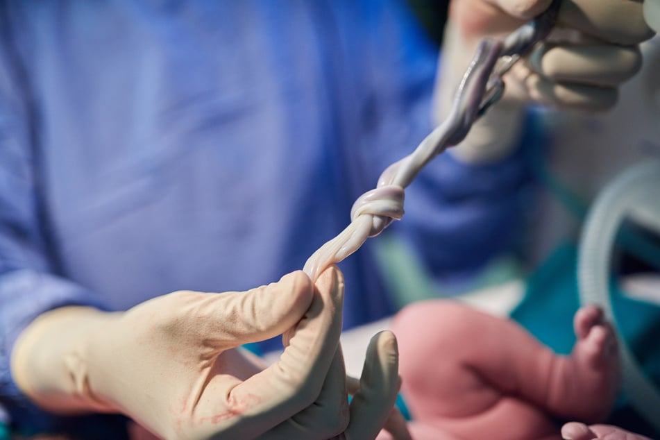 Beim Durchschneiden der Nabelschnur trennte eine Hebamme den Finger des Kindes ab. (Symbolfoto)