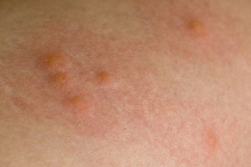 Juckreiz, Rötungen, Schwellungen bis zu blutenden Entzündungen - auf Mückenstiche reagiert jeder Mensch unterschiedlich.