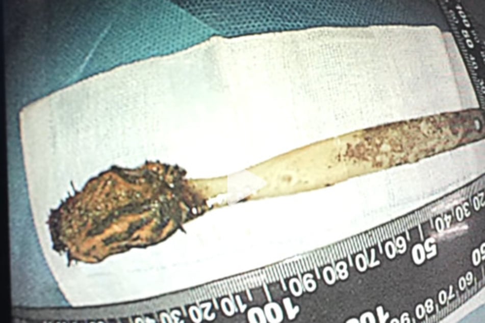 Diese Zahnbürste hatte der Patient 52 Jahre lang in seinem Dünndarm.