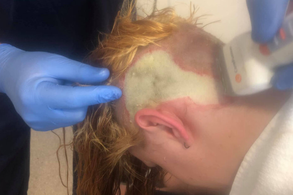 So grausam: Annaliese Fox benötigt wohl gleich mehrere Hauttransplantationen.