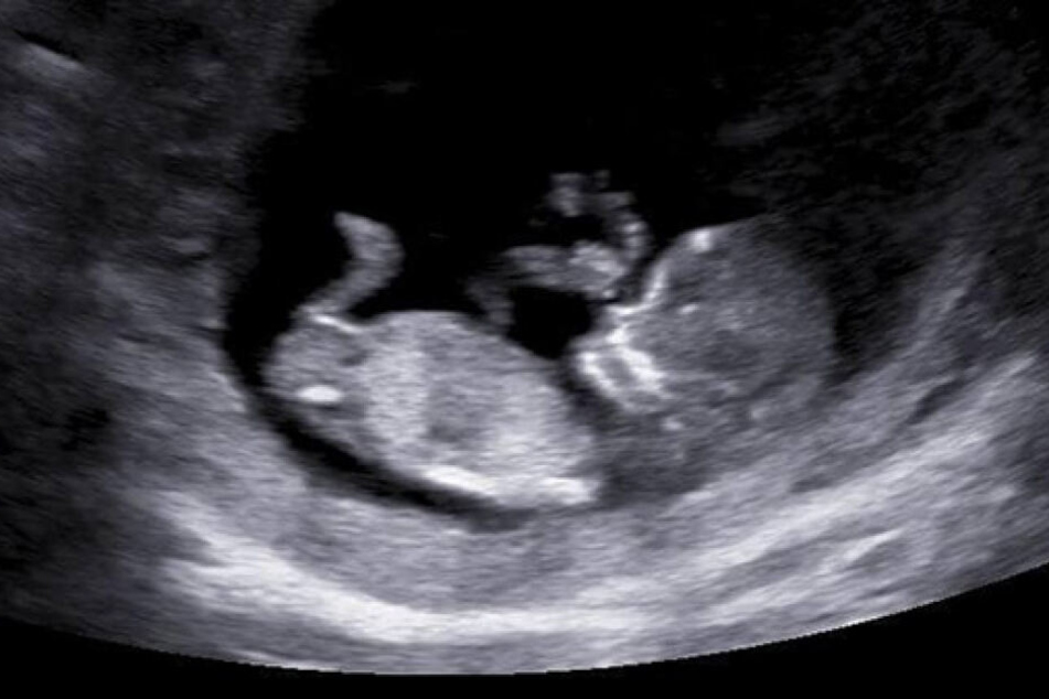 Vor der Geburt postete sie noch stolz Ultraschallbilder auf Facebook.