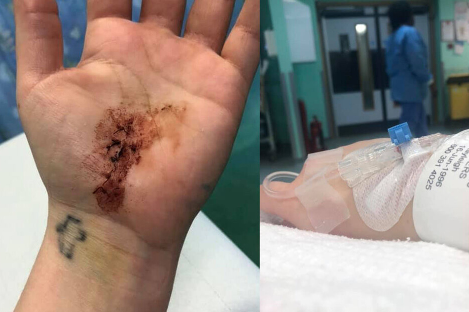 Kayleigh wird für immer eine Narbe an der Handinnenfläche tragen und sie an den Vorfall erinnern.
