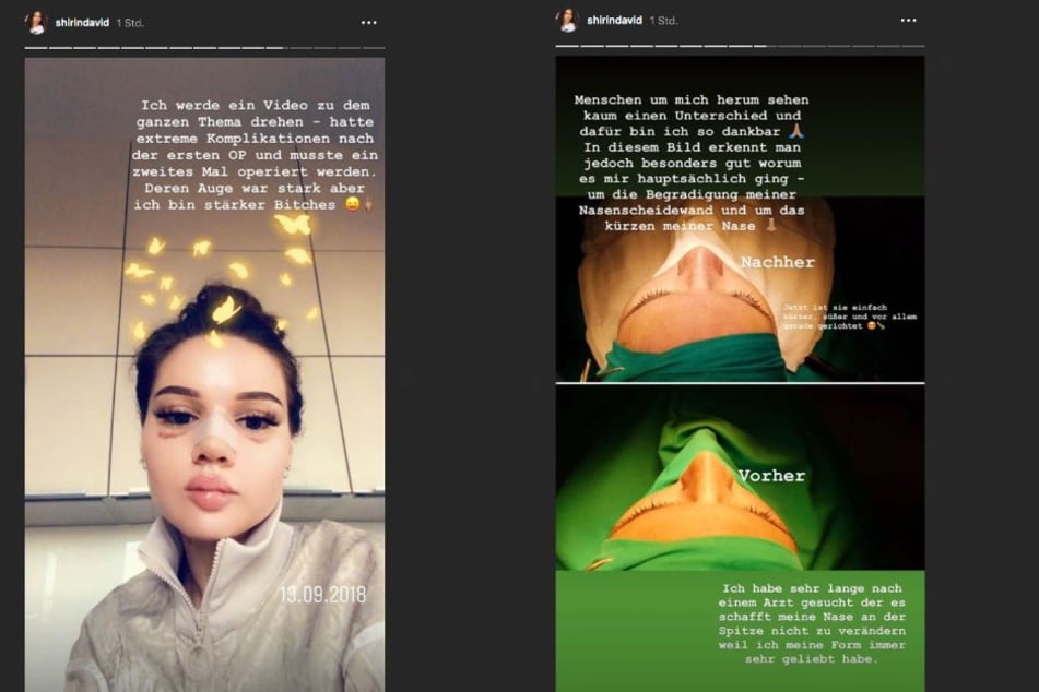 Shirin David (23) präsentiert ihre neue Nase auf Instagram.
