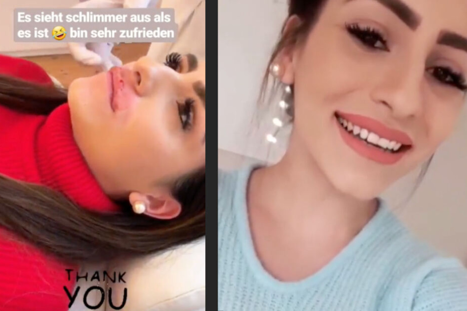 Die 26-Jährige ließ sich ihre Lippen mit Hyaluron unterspritzen.