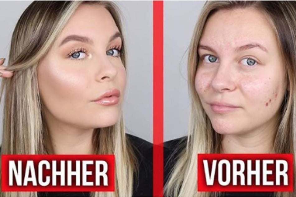 Dagi Bee (24) steht zu ihren Hautunreinheiten und spricht offen darüber.