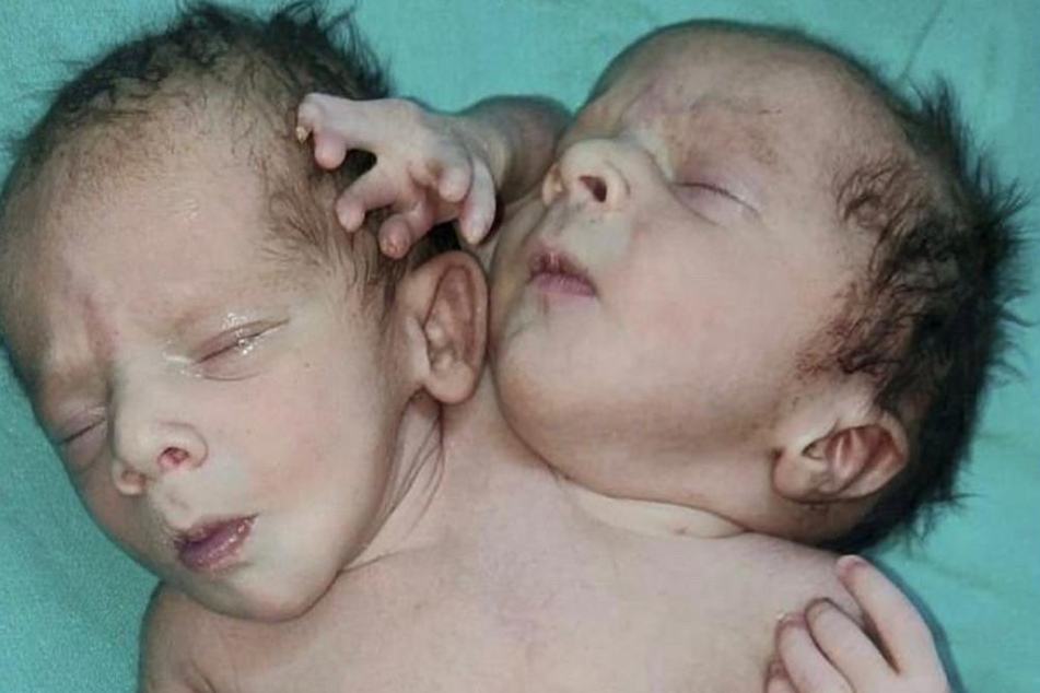 Eltern hatten Zwillinge erwartet: Mutter bringt Baby mit zwei Köpfen und drei Händen zur Welt