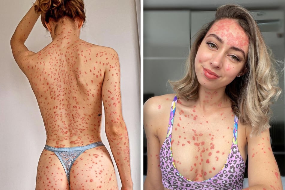 Rote Punkte am ganzen Körper: Junge Frau mit Hautkrankheit will sich nicht mehr verstecken
