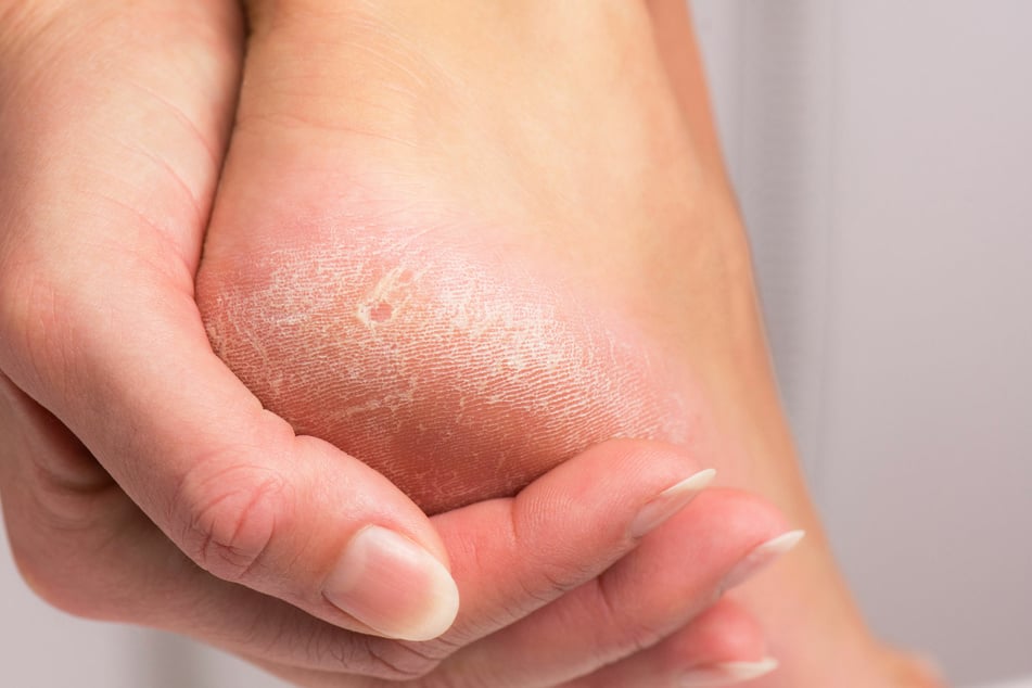 Calluses, even if they're not aesthetically pleasing, fulfill an important role.