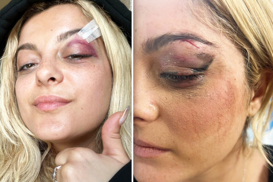 So schlimm sah Bebe Rexha (33) nach der Handy-Wurfattacke aus. Die Wunde musste sogar genäht werden.