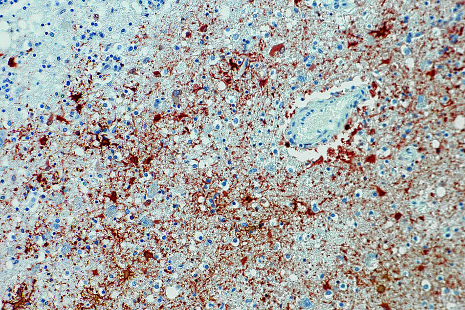 Die Aufnahme zeigt einen Antikörpernachweis zum Borna-Virus im Gewebe.
