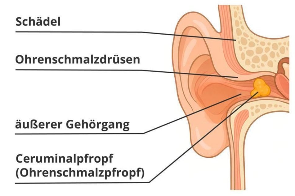 Ein Ohrenschmalzpfropf kann durch falsche Reinigung tiefer in den Gehörgang geschoben werden.