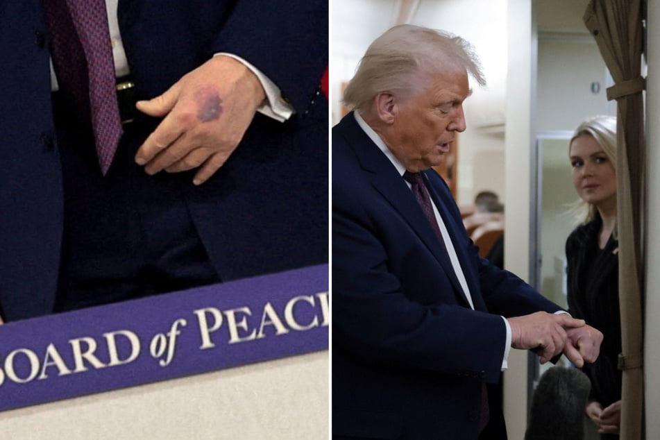 Trump tries to explain away latest hand bruise after "Board of Peace" photos raise questions