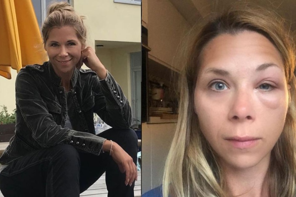 Tanja Szewsczenko (41) hat mit den Folgen eines Wespenstichs zu kämpfen.