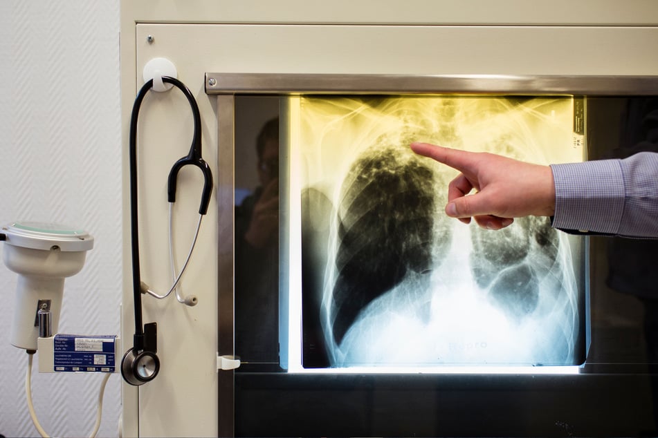 Tbc wird durch Bakterien verursacht. Am häufigsten ist die Lunge betroffen und Erkrankte leiden an länger anhaltendem Husten.