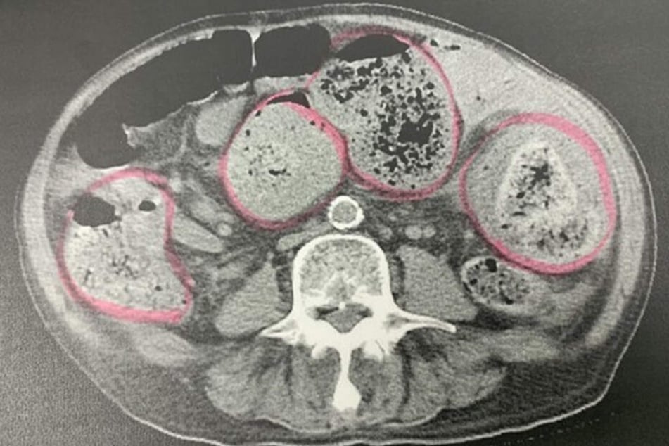 Auf dem Röntgenbild sah man den heftig verstopften Darm.