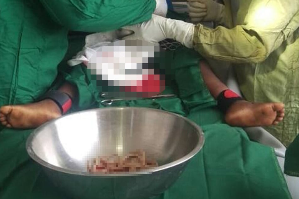 Die Ärzte mussten Dutzende Würmer aus dem Darm des Kindes entfernen.