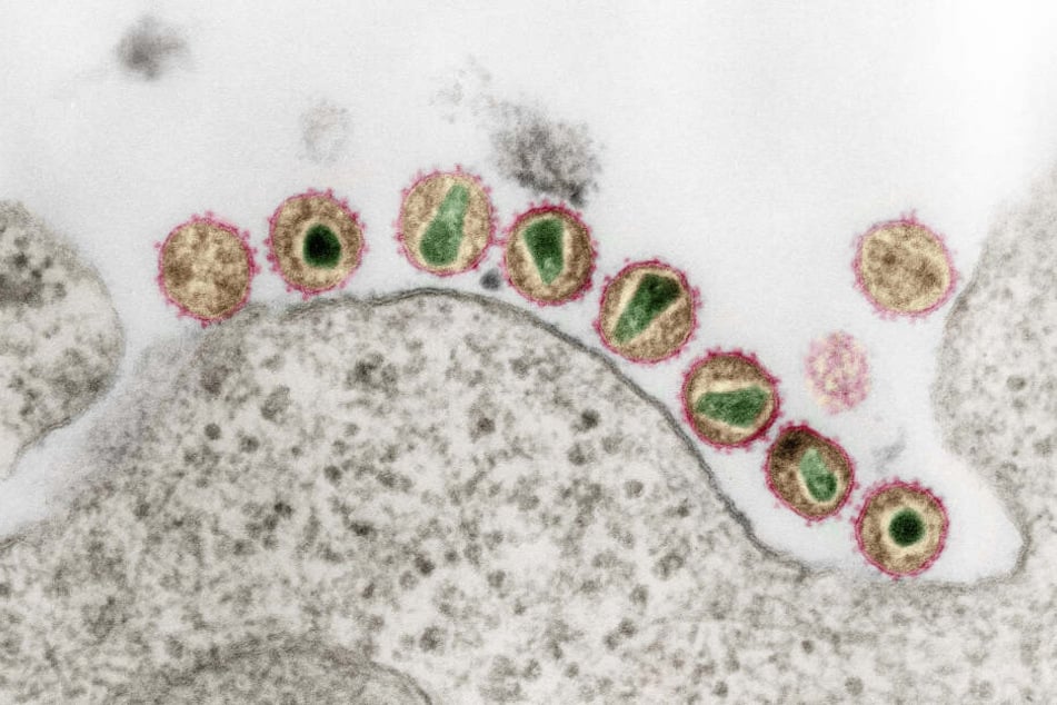 Ein Mann aus Düsseldorf, der sich mit HIV infiziert hatte, gilt einer Stammzelltransplantation als geheilt.
