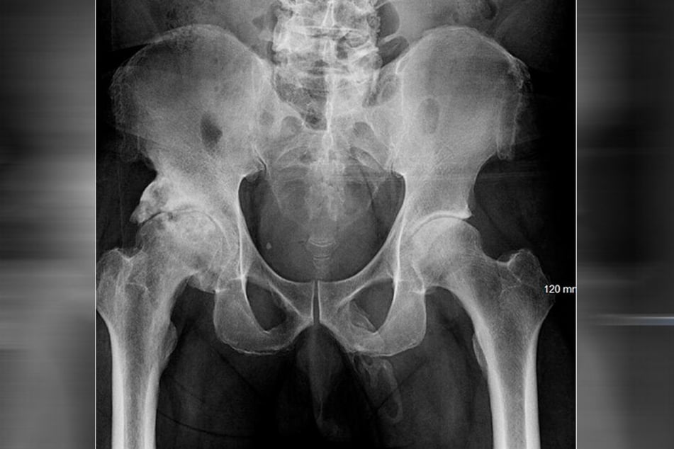 Die Röntgenaufnahme zeigt schwere Veränderungen der rechten Hüfte und eine ausgedehnte, plaqueartige Verkalkung entlang des Penis.
