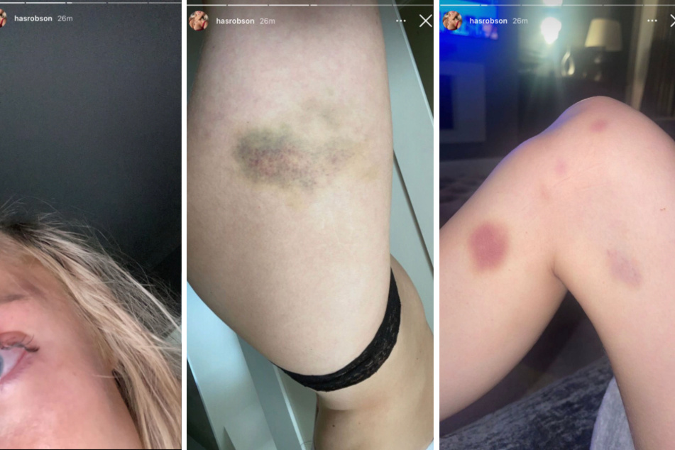 Harriet Robson (22) teilte auf Instagram Fotos von blauen Flecken auf ihrem Oberkörper und den Oberschenkeln.
