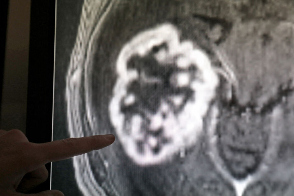 In der Diagnostik der Radiologie wird mit Hilfe der Magnetresonanztomographie ein Tumor festgestellt.